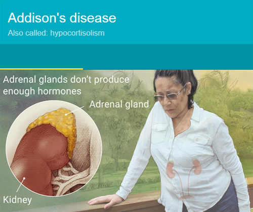 Adrenal Insufficiency - Addison's Disease