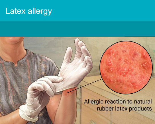 What to Know About Latex Allergies